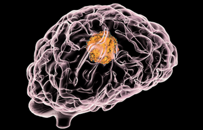 Brain Tumor Illustration