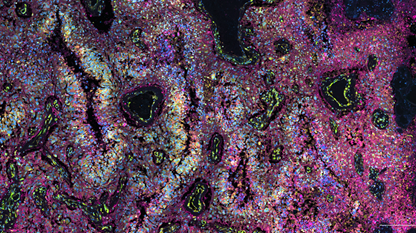 In Situ Transcriptomics (Xenium) Image of Glioblastoma