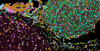 In Situ Transcriptomics (Xenium) Image of Multiple Sclerosis Lesion